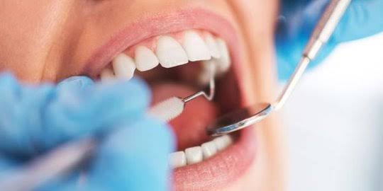 7 Cara Mencegah Munculnya Karang Gigi